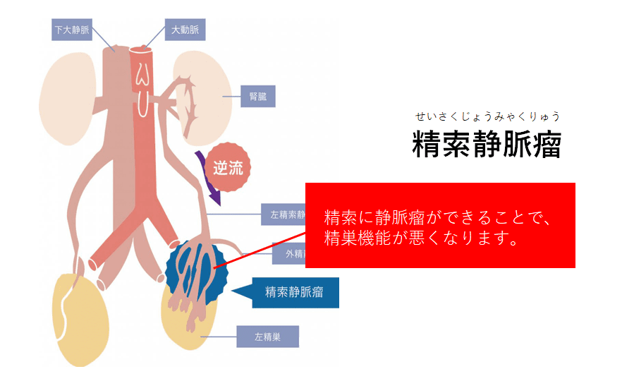 精索静脈瘤手術