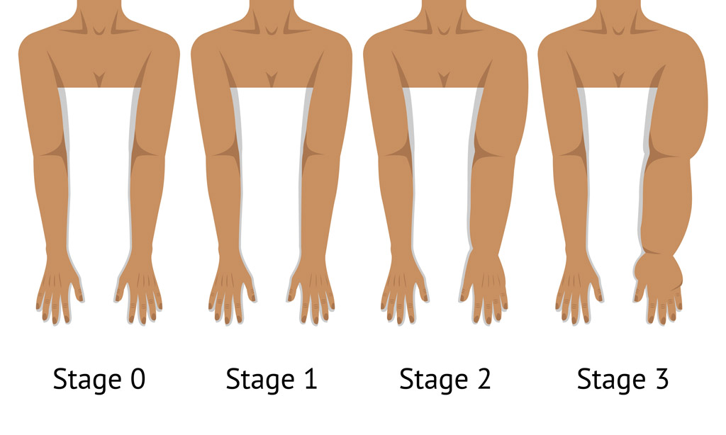 リンパ浮腫のステージ